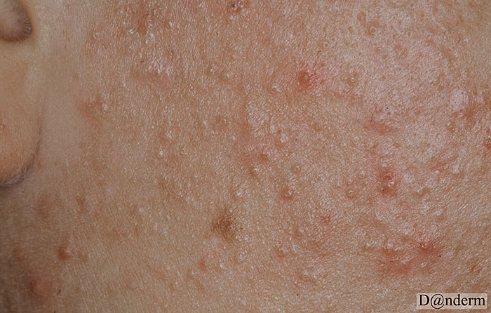 accutane treatment for keratosis pilaris