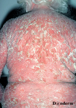 Exfoliative Psoriasis