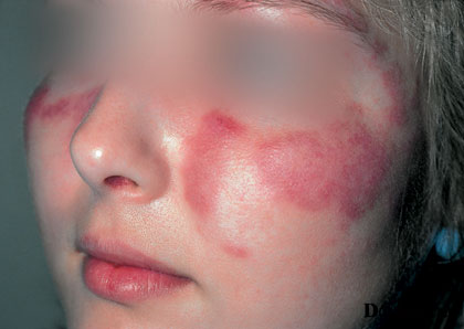 6-1 Systemic lupus erythematosus